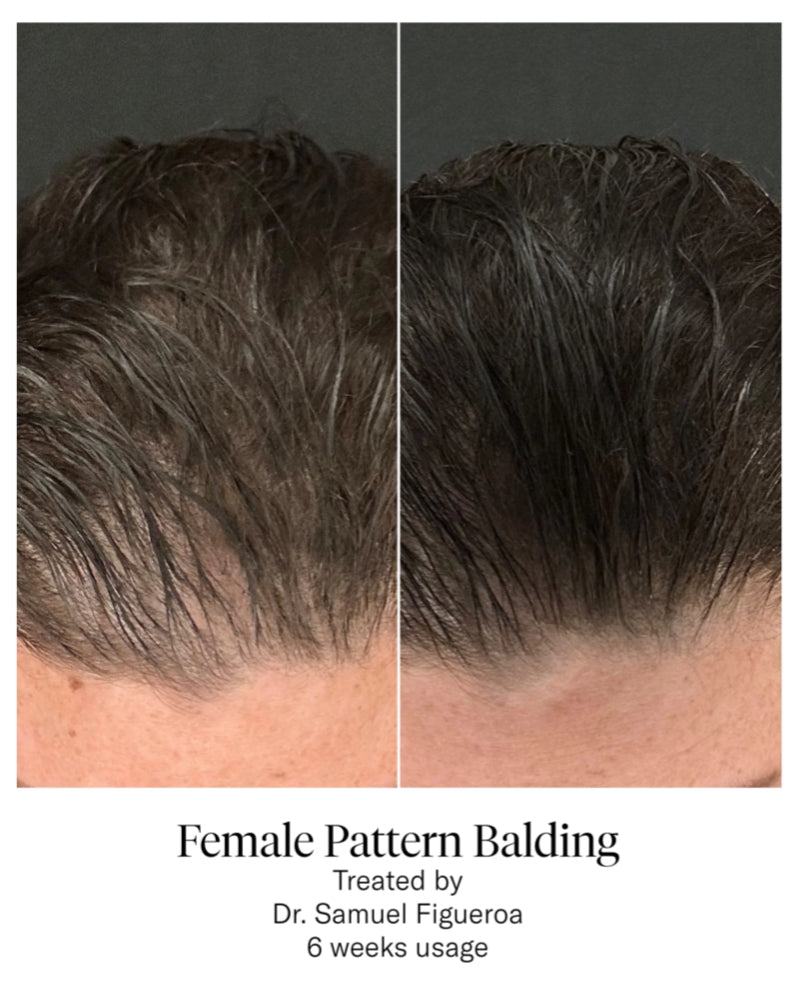 CALECIM PROFESSIONAL ADVANCED HAIR SYSTEM 6x5ml plus Home Activator