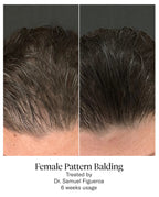 CALECIM PROFESSIONAL ADVANCED HAIR SYSTEM 6x5ml plus Home Activator