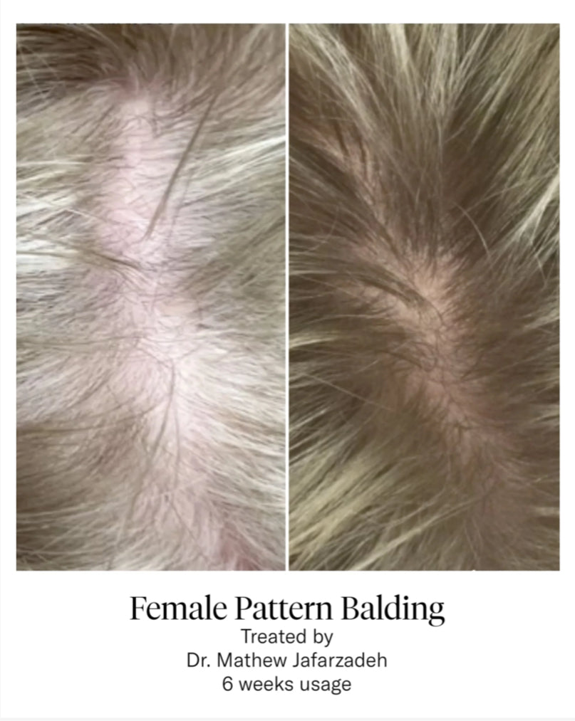 CALECIM PROFESSIONAL ADVANCED HAIR SYSTEM 6x5ml plus Home Activator